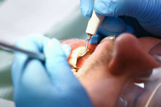 Best Emergency Tooth Extraction in Hazel Crest, IL